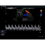 Köldökzsinór Color Doppler képe - MySono U6