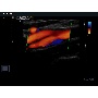 Carotis Color Doppler képe - MySono U6
